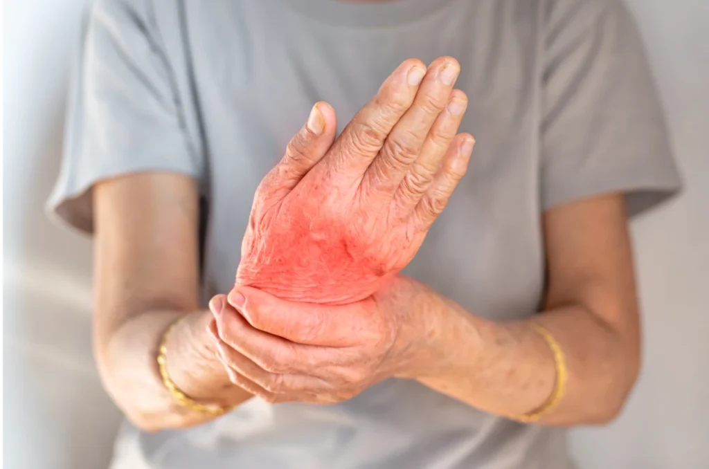 Diagnostico e tratamento da artrite reumatoide Diagnostico e tratamento da artrite reumatoide